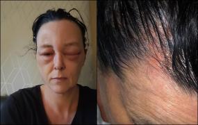 O mamă de 41 de ani din Anglia a ajuns de nerecunoscut, după ce a făcut o reacţie alergică oribilă la vopseaua de păr