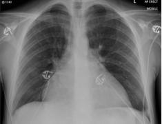 Medici spun că problemele cardiace ale bărbatului sunt rezultatul consumului de băuturi energizante