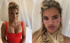 Tilly s-a ales cu cicatrici ale feței și orbire temporară