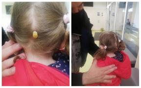 O fetiţă s-a trezit cu o căpuşă uriaşă prinsă de cap, după ce s-a jucat într-un parc din Suceava