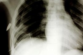 Radiografia unui om împuşcat în zona toracelui (scop ilustrativ)