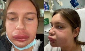 O femeie care a încercat să îşi dizolve acidul din buze a ajuns de urgenţă la spital cu faţa umflată:  "Arătam ca Homer Simpson"