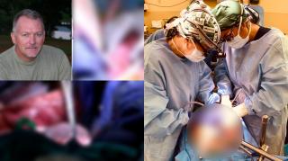 Transplantul a fost realizat cu succes