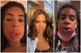 Marwa Merazka, probleme după intervenţia estetică la buze