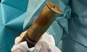 Spital evacuat după ce un bătrân din Franța a venit cu un obuz în posterior: "Așa ceva, n-am mai găsit!"