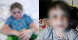 Băieţelul a fost desfigurat de câinele vecinului