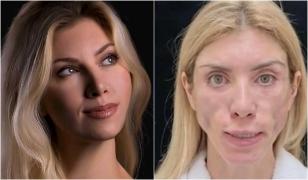 O regină a frumuseţii din Rusia a rămas desfigurată în urma unui tratament de 5.000$. "Nu mai pot închide ochii"