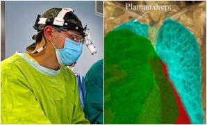 O intervenţie de succes care a durat 10 ore a salvat viaţa unui bărbat de 54 de ani. Pacientul era internat la Spitalul Universitar cu o tumoră gigant