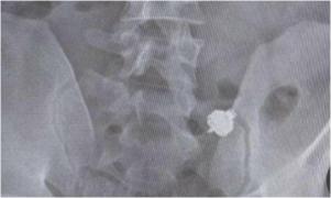 Un italian prins în timp ce copia la examenul auto a înghițit casca pe care o avea în ureche, crezând că va scăpa de consecințe