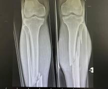 tânăr operat timp de 6 ore la Spitalul din Arad