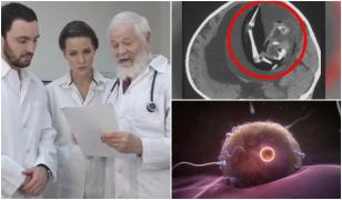 O fetiţă şi-a absorbit fratele în uter. Rămăşiţele lui îi presau pe creier, au descoperit medicii