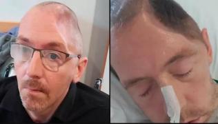 "Un singur pumn, de atât a fost nevoie!" Un englez a rămas fără jumătate de craniu şi cu un handicap grav după ce a fost lovit de un bărbat beat