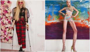 Femeia care și-a lungit picioarele cu 14 centimetri regretă enorm procedura. Cum arată acum influenceriţa din Germania