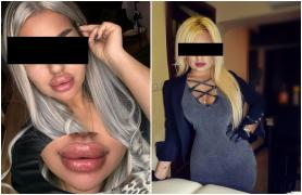 O femeie din Capitală, reţinută după ce s-a dat drept medic timp de aproape 2 ani. Făcea injectări cu acid hialuronic la clinici fără autorizaţie sanitară