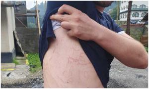 Cum arată un om, după ce fulgerul a lovit la doi paşi lângă el. I-au rămas semne pe tot corpul