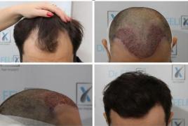 (P) Tehnologii moderne în implantul de păr: Ce trebuie să știi despre metodele FUE și FUT