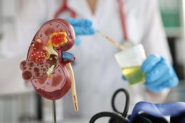 (P) Hematuria: cauze posibile și importanța diagnosticului diferențial