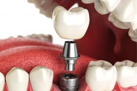 Ai dinți lipsă și cauți o soluție care să dureze? Uite ce îți recomandă specialiștii Megadent din Cluj-Napoca