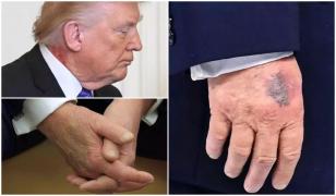 Trump va face controlul medical anual pe 26 mai. Îngrijorări privind vânătăile de pe mâini și gleznele umflate