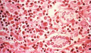 Hantavirus a ajuns în Europa. Un pasager care părăsise nava Hondius a fost testat pozitiv