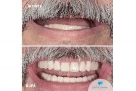 (P) Proteza dentară fixă pe implanturi: informații despre preț de la clinica Dental Premier din București