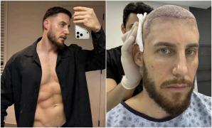 A vrut un transplant de păr ieftin în Turcia, dar a plătit scump greșeala. Ce a descoperit după 8 ani