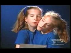 “Fată” cu două capete. Unul dintre ele s-a logodit