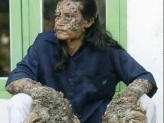 Povestea CUTREMURĂTOARE a OMULUI-COPAC! A ajuns aşa din cauza unui accident banal