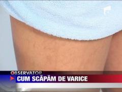 Felicia: Cum scapam de varice