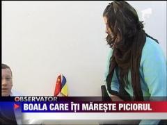 Acromegalia, boala care iti mareste piciorul