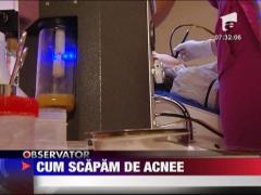 Cum scapam de acnee
