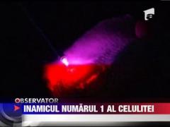Laserul, noul inamic al celulitei