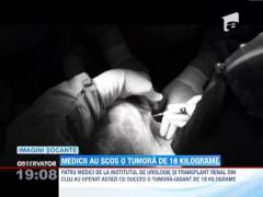 UPDATE! Medicii clujeni au extirpat o tumora de 18 kilograme, care chinuia o femeie