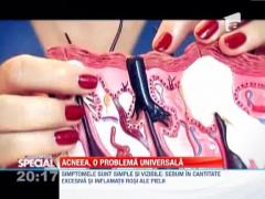 Observator Special: Acneea, o problema universala