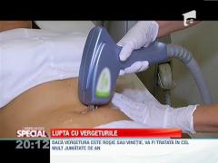 O nouă metodă de a scăpa de vergeturi: tratamentul pe bază radio-frecvenţă