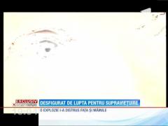 Un clujean desfigurat de o explozie, discriminat de angajatori