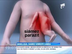 Bebeluşul siamez şi-a revenit perfect