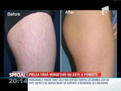 Special! Pielea fără vergeturi nu este o poveste
