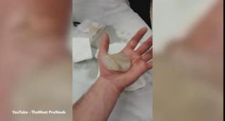 VIDEO: S-a ales cu o băşică imensă în palmă. A înțepat-o cu un ac! Ce a urmat depăşeşte orice imaginaţie