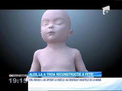 Alex, băiatul de patru ani mutilat de o explozie, la a treia reconstrucţie a feţei