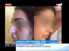 Care sunt avantajele rinoplastiei