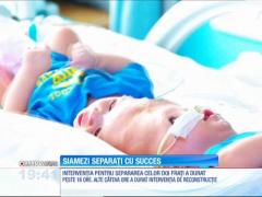Siamezi uniți în zona capului, despărțiți cu o operaţie extrem de delicată