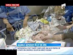 Doi fraţi siamezi au fost separaţi după o operaţie maraton