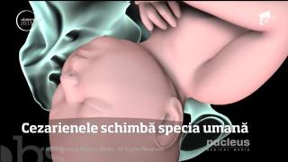 Naşterile prin cezariană schimbă specia umană