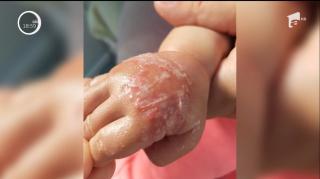 ȘOCANT la Spitalul din Slobozia! Bebeluş trimis acasă cu mâna umflată şi infectată de la o branulă ce n-ar fi fost verificată de ŞASE ZILE!