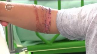 Un copil de doi ani are braţul drept infectat din cauza unei branule puse la spitalul din Slatina!