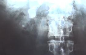 Un bărbat aduce acuzaţii grave de malpraxis unui medic de la Spitalul Judeţean de Urgenţă Bistriţa