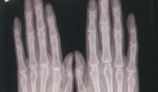 600 de mii de români diagnosticați cu boli reumatice, mulți dintre ei tineri