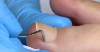 România este pe primul loc în Europa la numărul de bolnavi de hepatita C