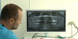 Gingii inflamate, sângerări şi chiar dinţi care se clatină. Primele semne care vă arată că suferiţi de parodontoză